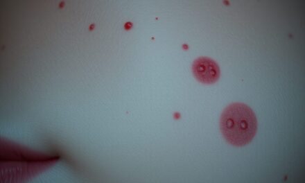 Bezsenność a trądzik: jak brak snu wpływa na skórę i na co zwrócić uwagę przy pielęgnacji