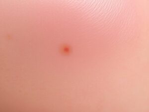 Przebarwienia po dermapen: przyczyny, ryzyko i jak minimalizować skutki pozabiegowe