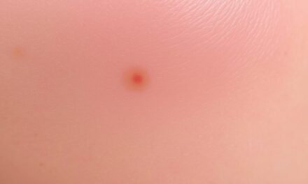 Przebarwienia po dermapen: przyczyny, ryzyko i jak minimalizować skutki pozabiegowe