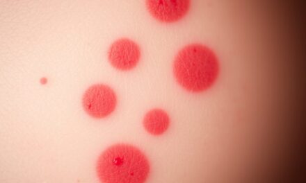 Czerwone plamy po trądziku: jak rozpoznać przyczyny i skutecznie wspierać regenerację skóry